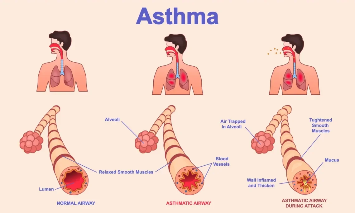 PKV Private Krankenversicherung Asthma